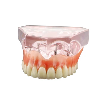  Обучение Модел На Зъбни Импланти 4 Зъбните Импланти Свалящ Възстановяване На Зъбната Протеза Розова Акрилна Демонстрационен Модел На Зъболекар Coolege